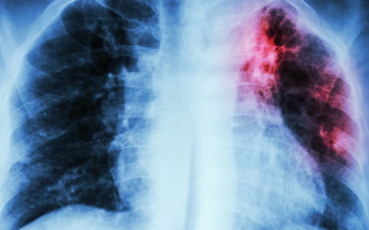 Enfermedad pulmonar obstructiva crónica (EPOC)