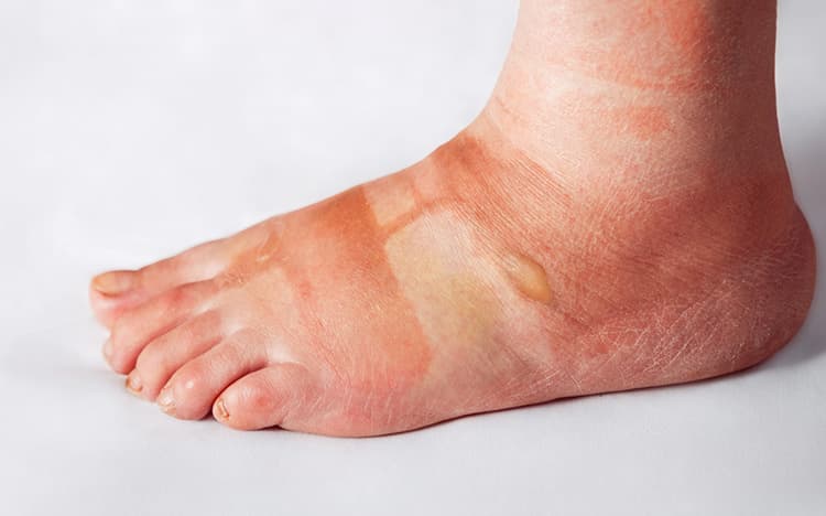 Edema (hinchazón de piernas o tobillos)